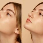 Practical Tips: Is Rhinoplasty In Turkey Worth The Price