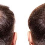 Hair Transplant Turkey