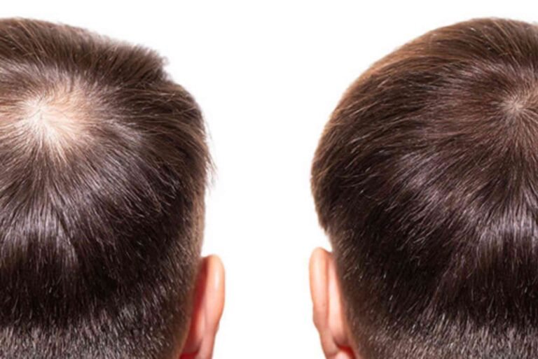 Hair Transplant Turkey