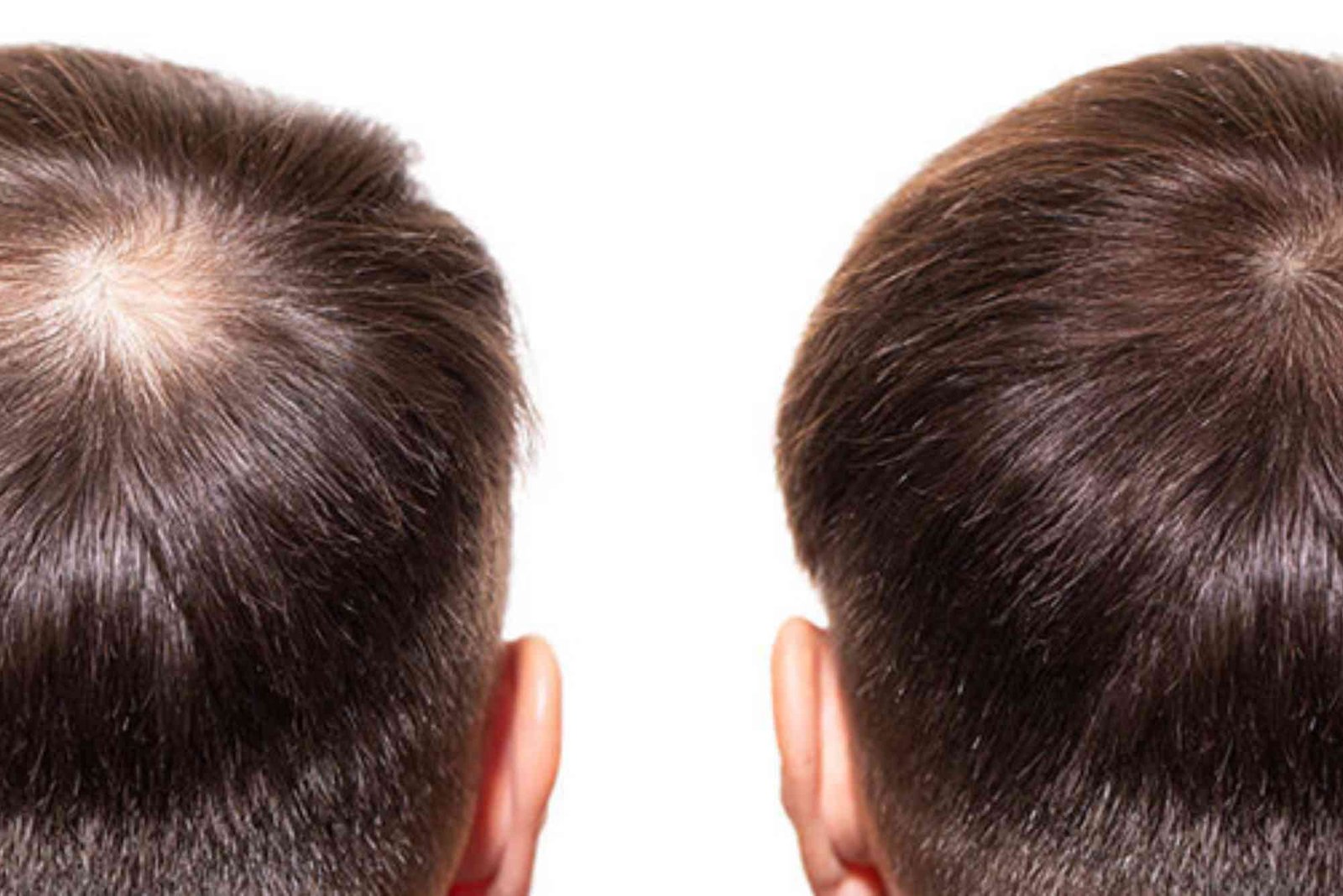 Hair Transplant Turkey